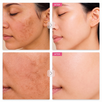 Before and after results on dark spots and melasma with the Cozylea Brightening Cream